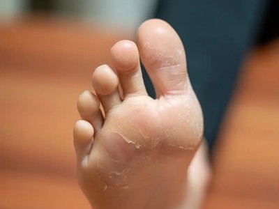 中藥治腳氣的十大藥方